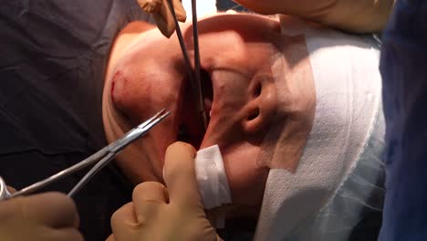 bichectomy,-jowl-liposuction,-surgery-in-operating-room,-doctor-operating-on-face,-cosmetic-surgery,-skin,-facelif