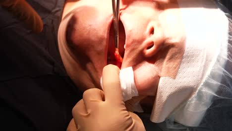 Bichektomie,-Plastische-Chirurgie-Zur-Verengung-Des-Mittleren-Bis-Unteren-Teils-Des-Gesichts,-Extraktion-Von-Wangenfett