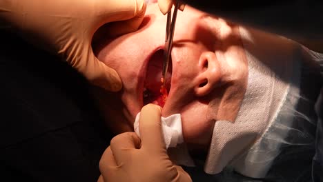 Bichektomie,-Plastische-Chirurgie-Zur-Verengung-Des-Mittleren-Bis-Unteren-Teils-Des-Gesichts,-Patient,-Extraktion-Von-Wangenfett
