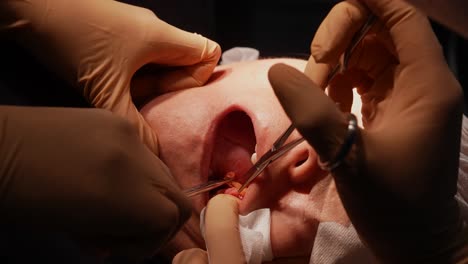 Bukkale-Fettentfernung,-Bichektomie,-Plastische-Chirurgie-Zur-Verengung-Des-Mittleren-Bis-Unteren-Teils-Des-Gesichts