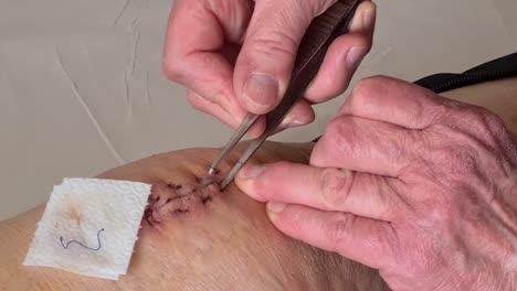 nurse-removes-stitch-from-the-wound-that-has-been-heal-after-operation,-removed-stitches-are-placed-on-cotton-paper