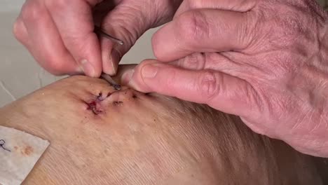 nurse-removes-stitch-with-tweezers-from-the-wound-that-has-been-heals-after-knee-operation