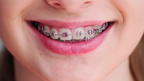 View-of-teeth-with-dental-brace