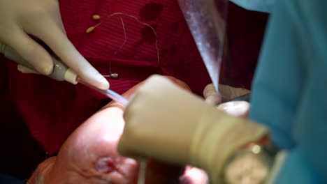 Dentists'-hands-in-sterile-gloves-using-dental-tools-for-a-male-elderly-patient's-oral-treatment