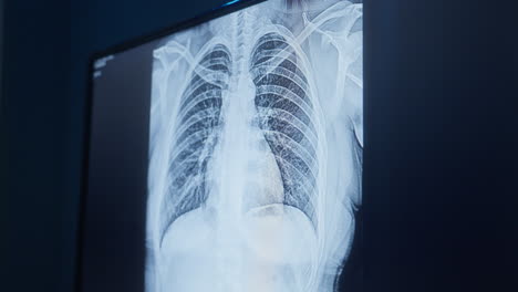 Das-Ergebnis-Der-Röntgenaufnahme-Des-Brustkorbs-Wird-Auf-Dem-Bildschirm-Angezeigt.-Nahaufnahme