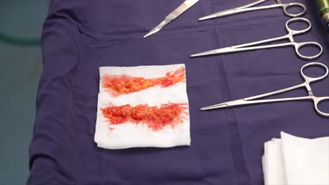 scissors-in-hospital-operating-room,-fat-removed-during-liposuction