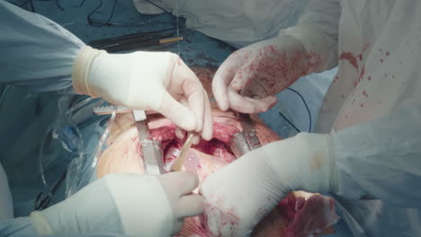 assistant pours solution onto heart. skilled cardiothoracic surgeons operate patient performing coronary artery bypass surgery in operating room