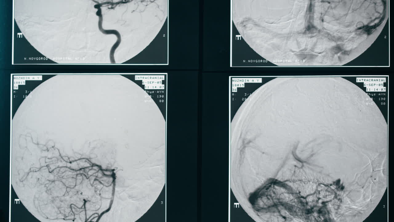 Dynamic Cerebral Angiogram Displaying Brain Vasculature
