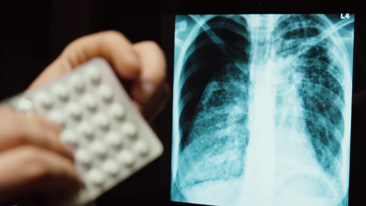 Close-up of a lung X-ray on a screen while a hand points to the image and holds medication tablets. Concept of medical diagnosis, respiratory disease treatment, and healthcare consultation
