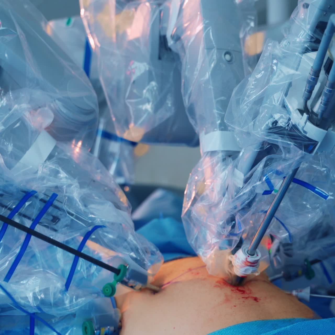 Da Vinci Surgery. Medical operation involving robot. Future of Medicine