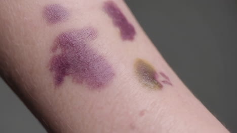 skin lesions and bruises on forearm