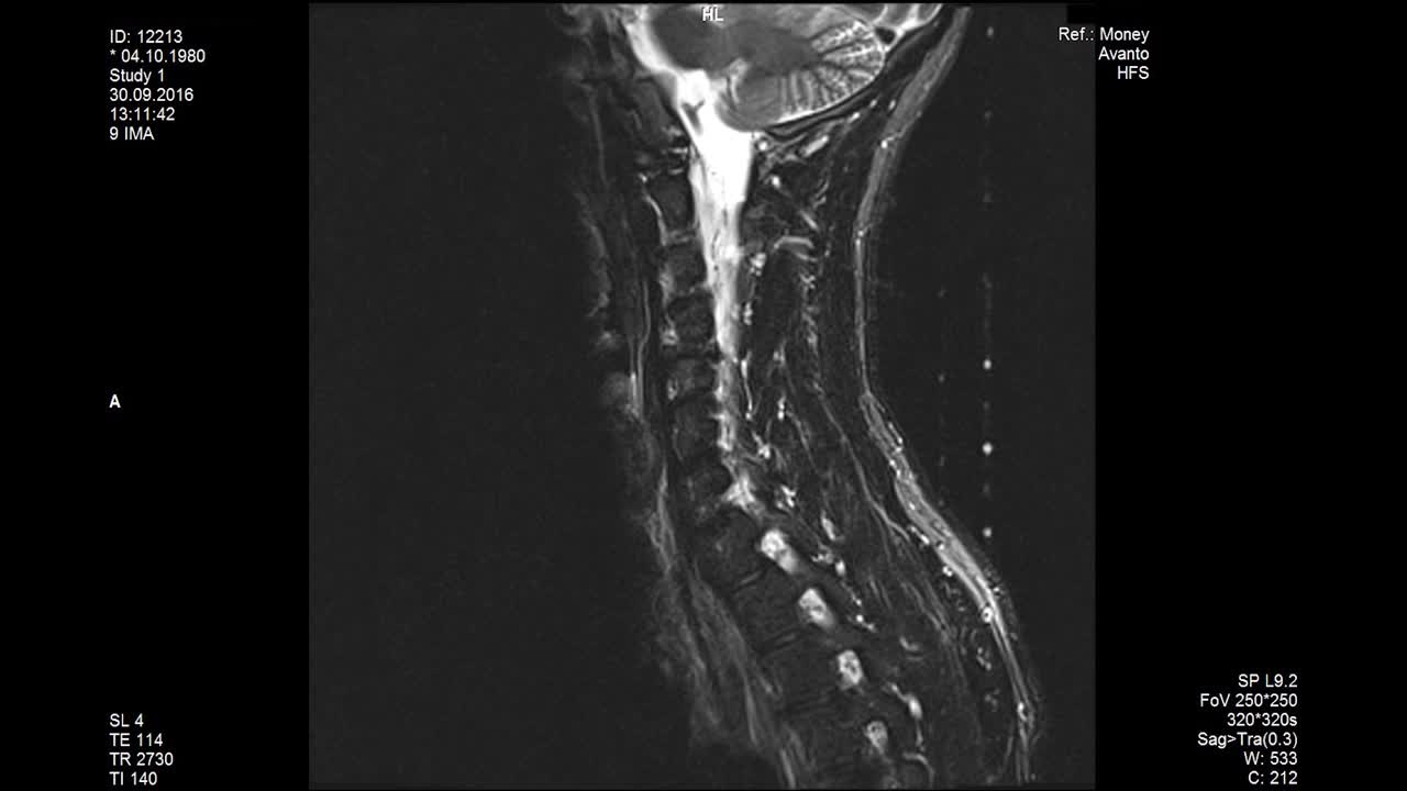 MRI scans the lumbar spine