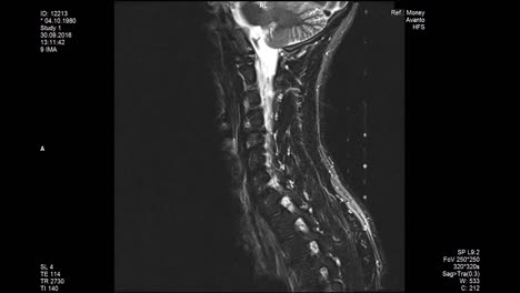 mri scans the lumbar spine