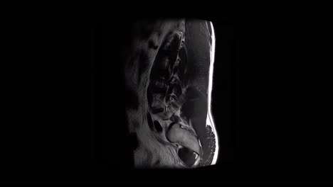 mri scan of a male lumbar spine exhibiting a lightly herniated disc, scanning from side to side