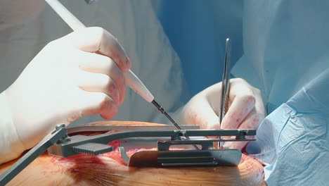 doctor conducts laser surgery in clinic closeup. surgeon in gloves operates with forceps and hot scalpel during coronary artery bypass surgery in room