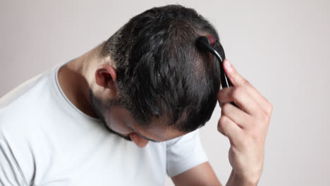 Hombre-Usando-Dermaroller-En-Parches-Calvos-Para-El-Crecimiento-Del-Cabello-En-Fondo-Blanco,-Tratamiento-Para-La-Calvicie-De-Patrón-Masculino