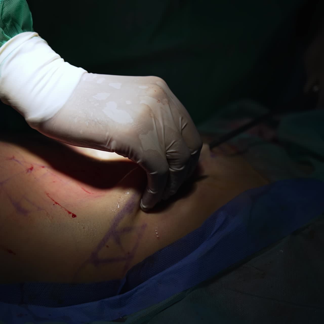 Plastic surgeon pumping fat from abdomen. Liposuction on patient's belly. Fat transfer surgery. Surgical treatment of patient with overweight. Close-up