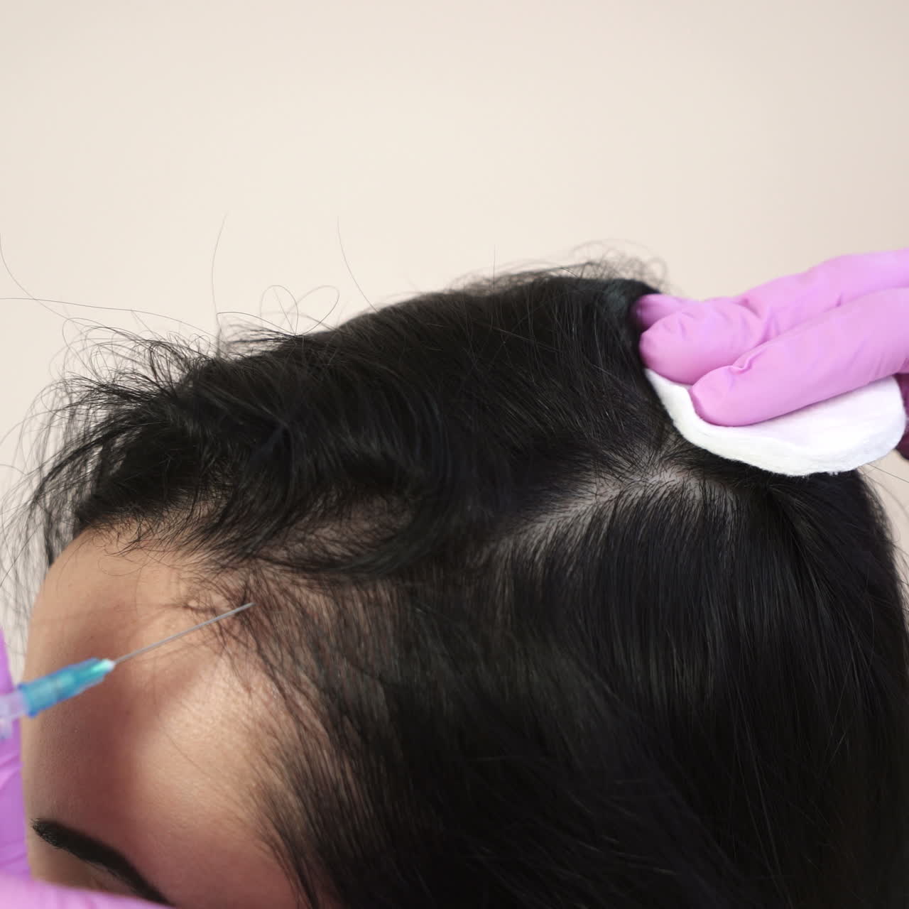 Needle mesotherapy. Cosmetic been injected in woman's head. Thrust to strengthen hair and their growth