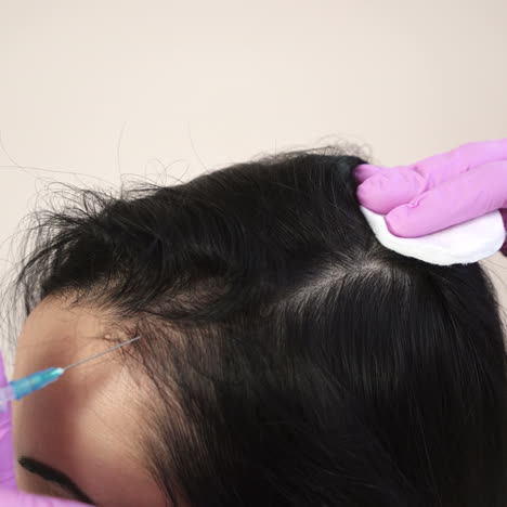 needle mesotherapy. cosmetic been injected in woman's head. thrust to strengthen hair and their growth