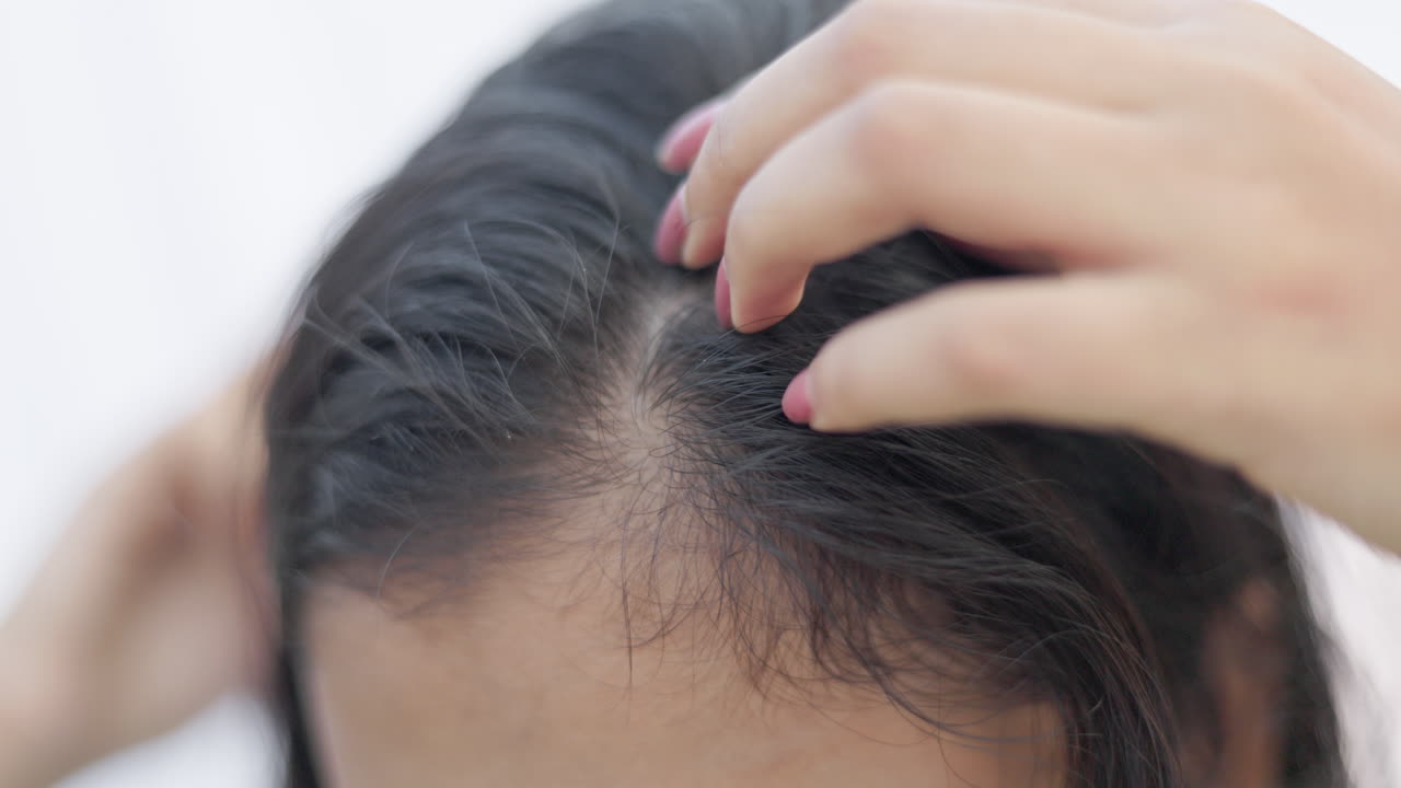 Hair loss, androgenic alopecia, hairfall. Indian young woman showing her receding hairline.