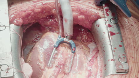 retractors open chest cavity for surgery. metal blades correctly positioned provide surgeon access to organ creating optimal operating conditions