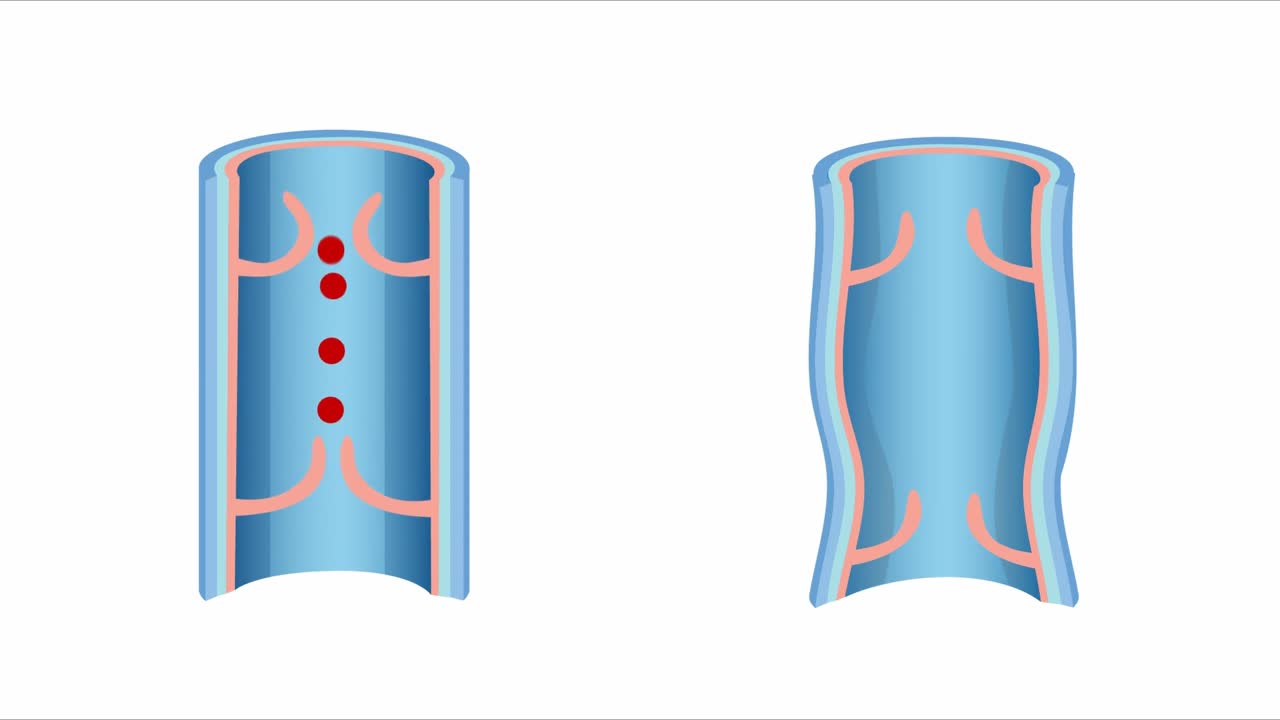 정맥 질환의 2d vfx