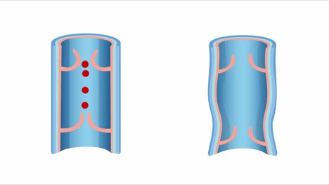 2D-VFX-of-Vein-disease