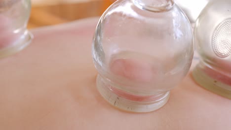 physiotherapist performing cupping therapy on a patient's back