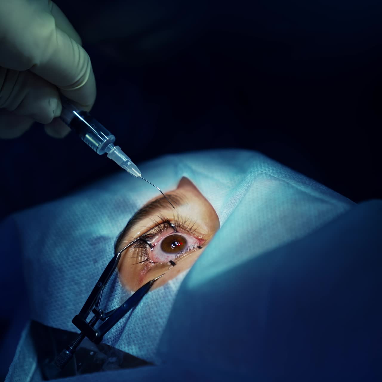 Correzione della vista con il laser. Un paziente e un team di chirurghi nella sala operatoria durante un intervento di chirurgia oftalmica. Divaricatore palpebrale. Trattamento Lasik. Paziente sotto copertura sterile