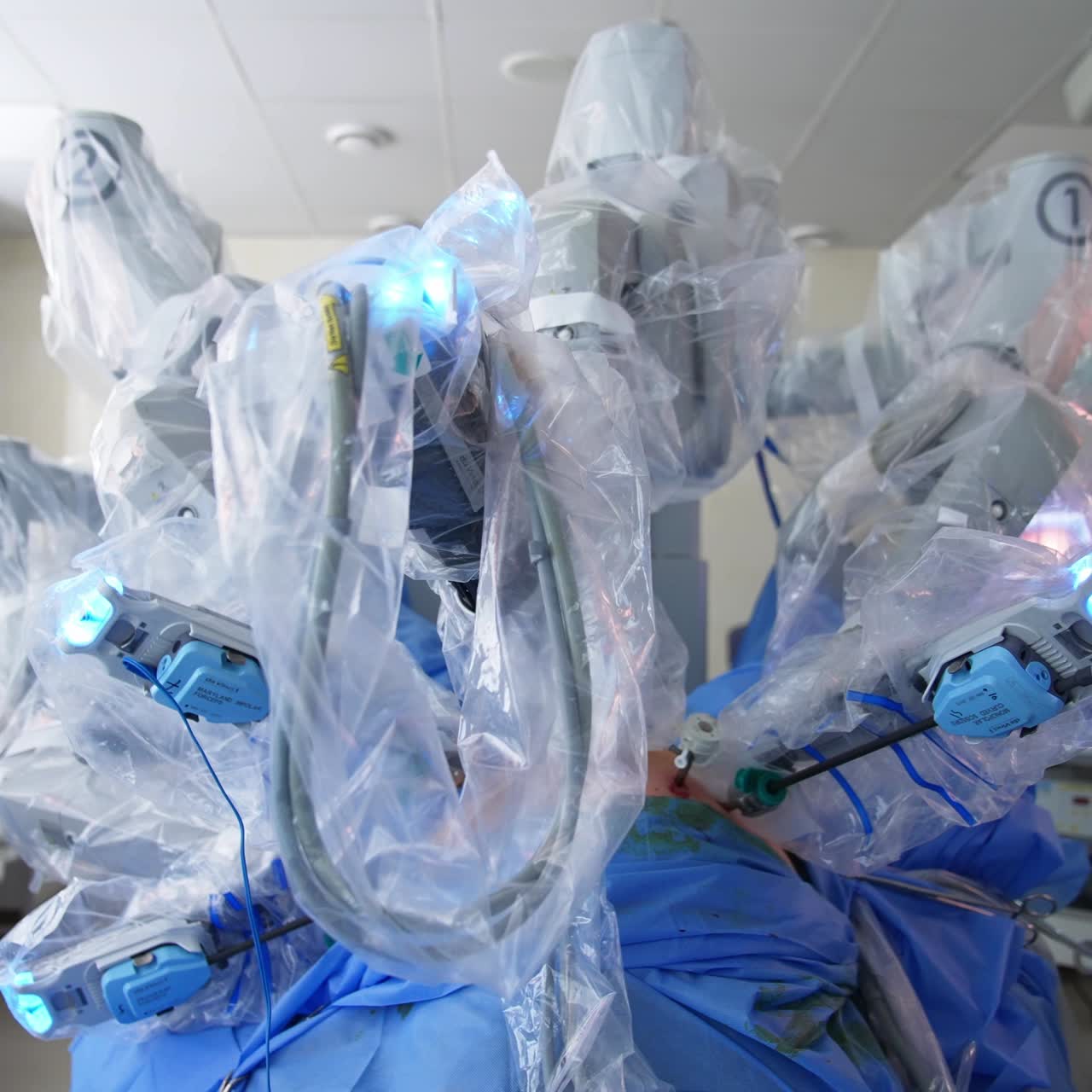 Patient is operated by high-precise robot. Numerous Da Vinci robotic arms moving slowly operating the human being