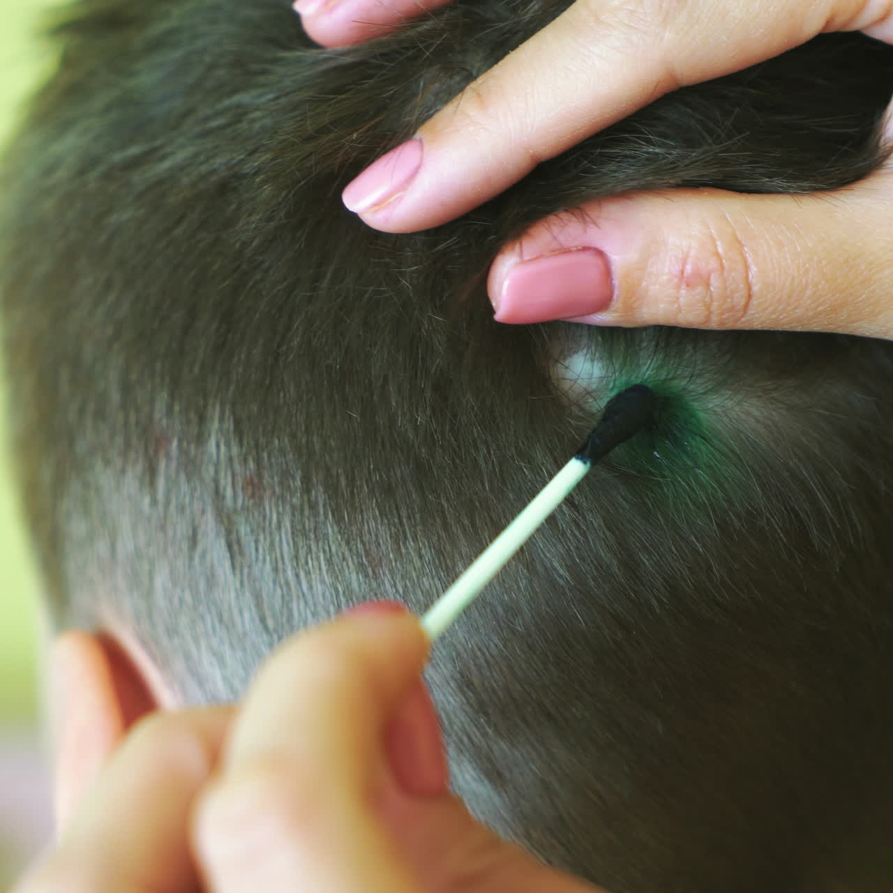 Little boy with chickenpox. Mother applying antiseptic solution to rash. Home treatment. Square video
