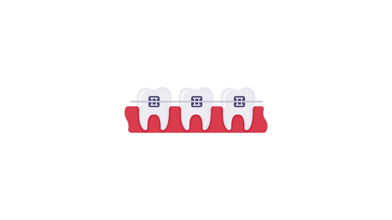 Illustrazione animata di denti con apparecchio ortodontico per l'allineamento