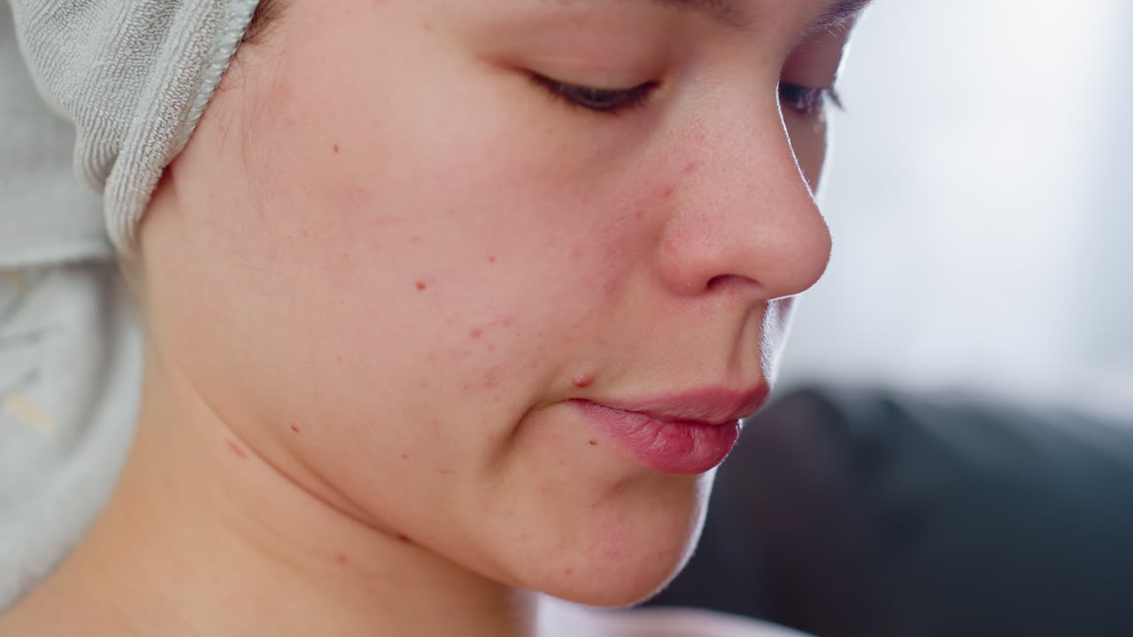 Close view of woman face showing visible pimples and natural skin imperfections with towel wrapped around hair, captured in soft light emphasizing skincare reality and authentic beauty