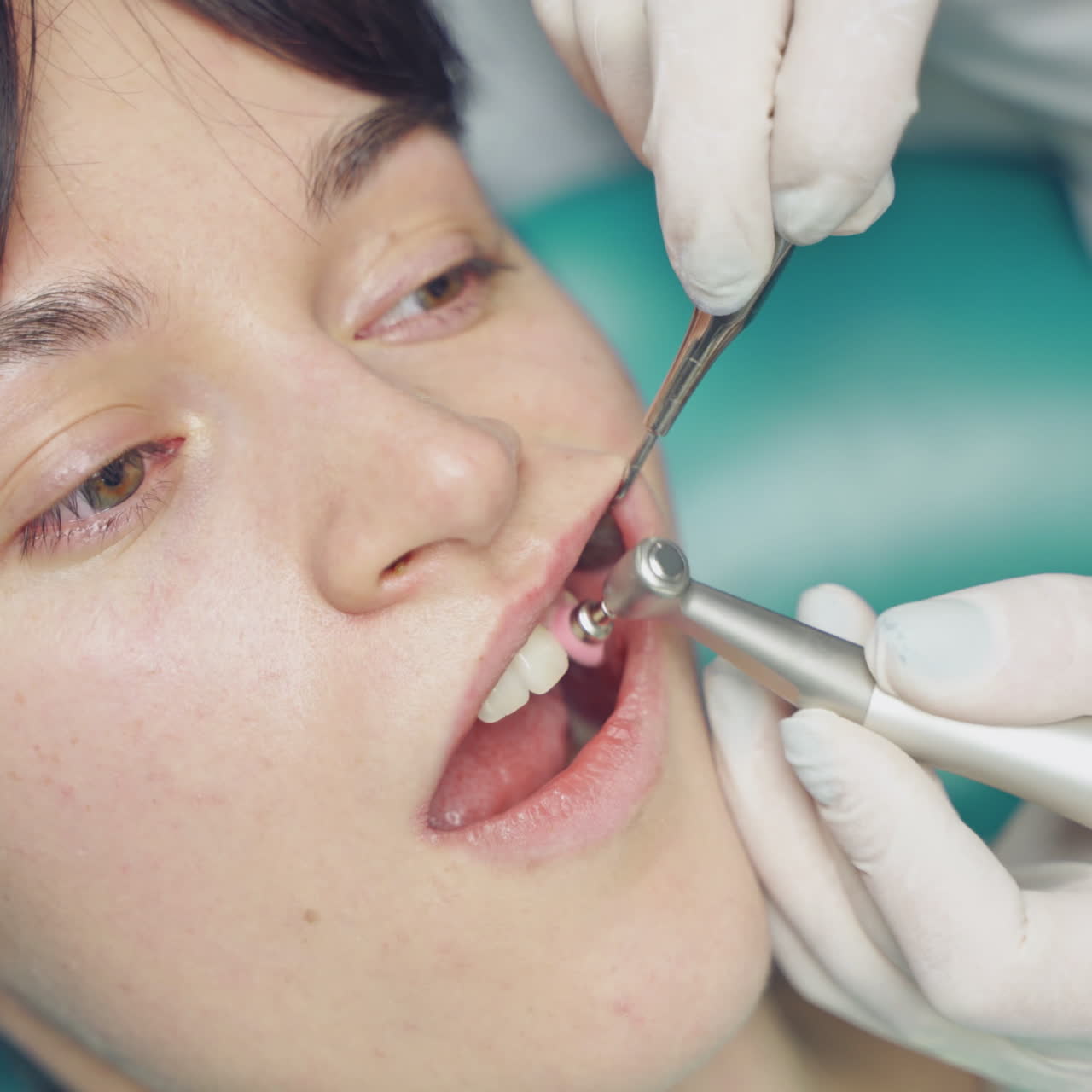 A dentist is doing the removal of deposits on the teeth and whitening for the client in the dental center. Close-up.