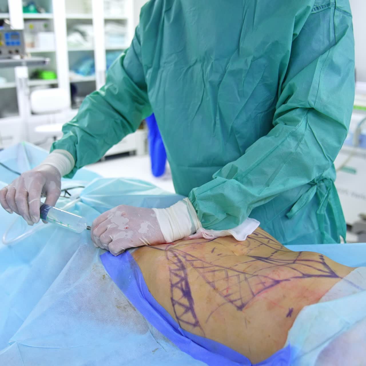 Professional of plastic surgery thrusts a huge needle syringe into a belly lined with a pen. Assistant passes a new syringe full of medicine to a doctor