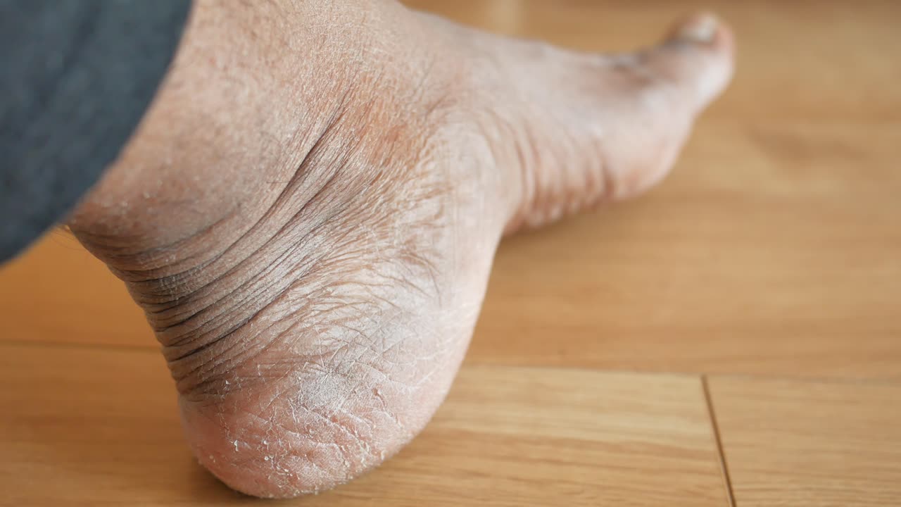 건조하고 은 발 뒤꿈치