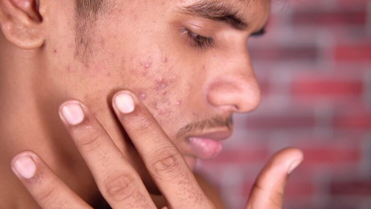 Acne on a Young Man's Face