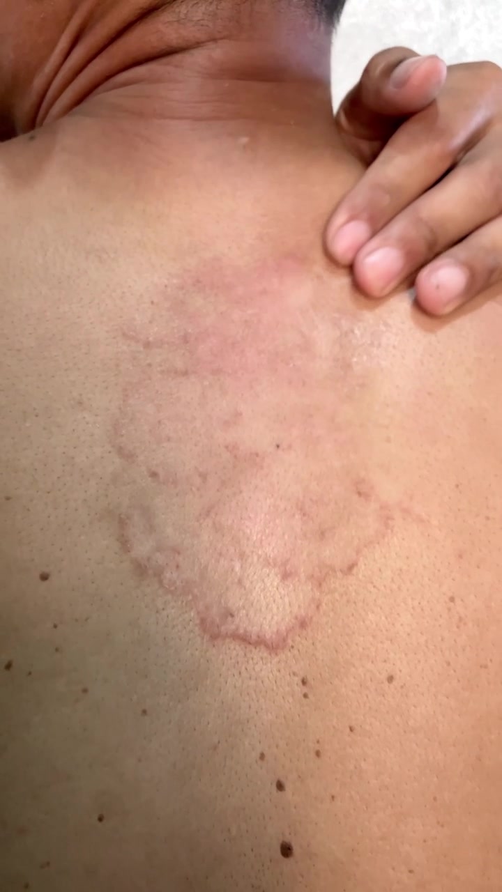 Sakte film vertikal nærbilde av en hånd som klør et stort, rødt, kløende ringormutslett på en persons rygg. Huden viser en alvorlig soppinfeksjon, allergi eller dermatitt som forårsaker ubehag.