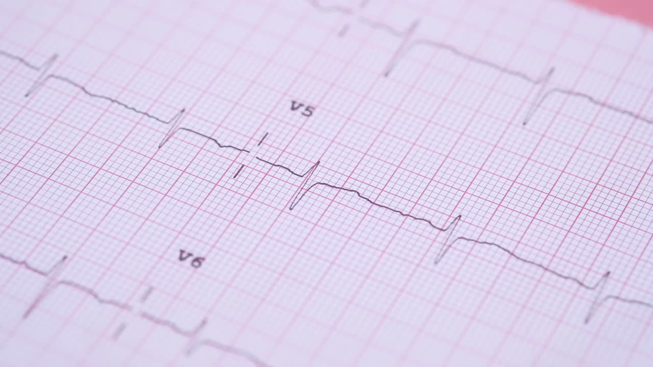 imágenes de electrocardiograma (ecg)