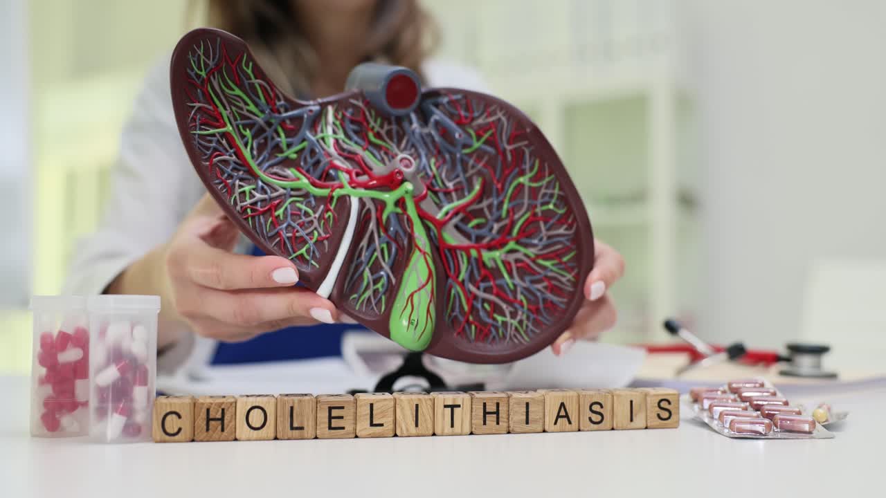 Medical professional holds a liver model with 'CHOLELITHIASIS' spelled out, illustrating gallstone disease