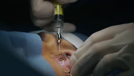 레이저 시력 교정: 안과 수술 중에 수술실에 있는 환자와 수술팀; 눈꺼풀 스럼; 라식 치료; 불임 개 아래의 환자
