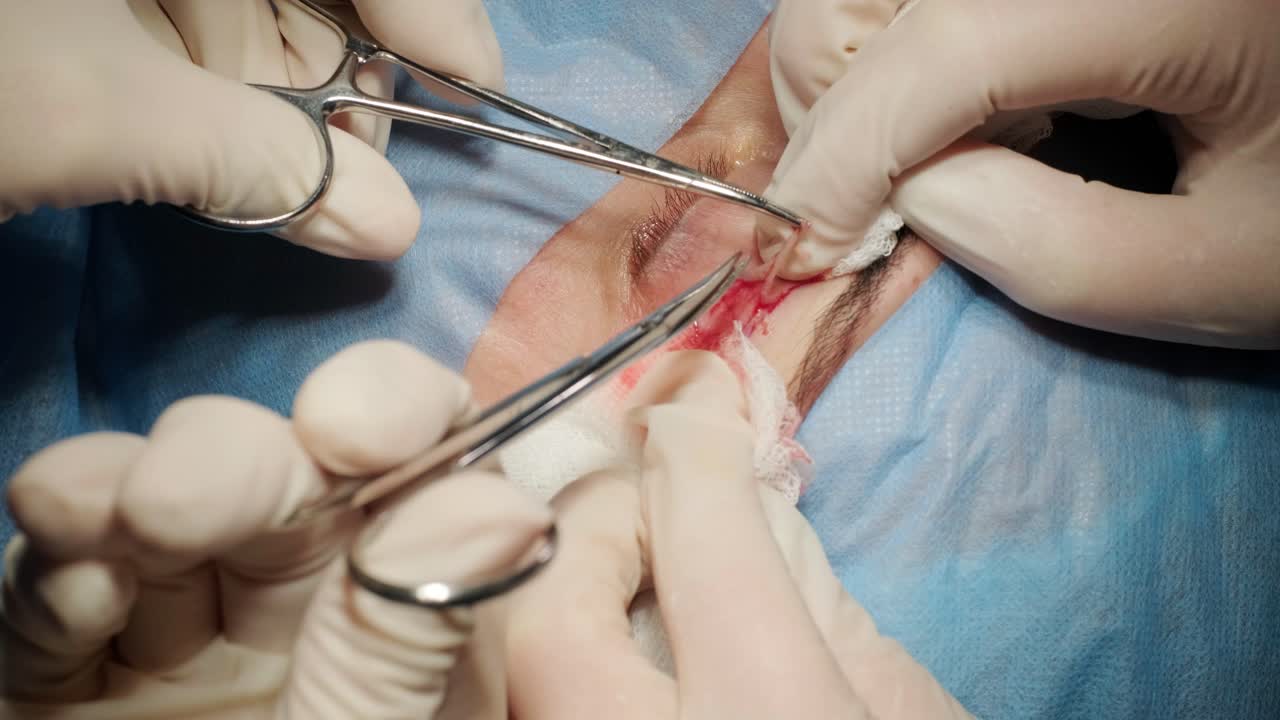 operación de cirugía plástica de blefaroplastia, centrada en el rejuvenecimiento y la modificación de la región del ojo.