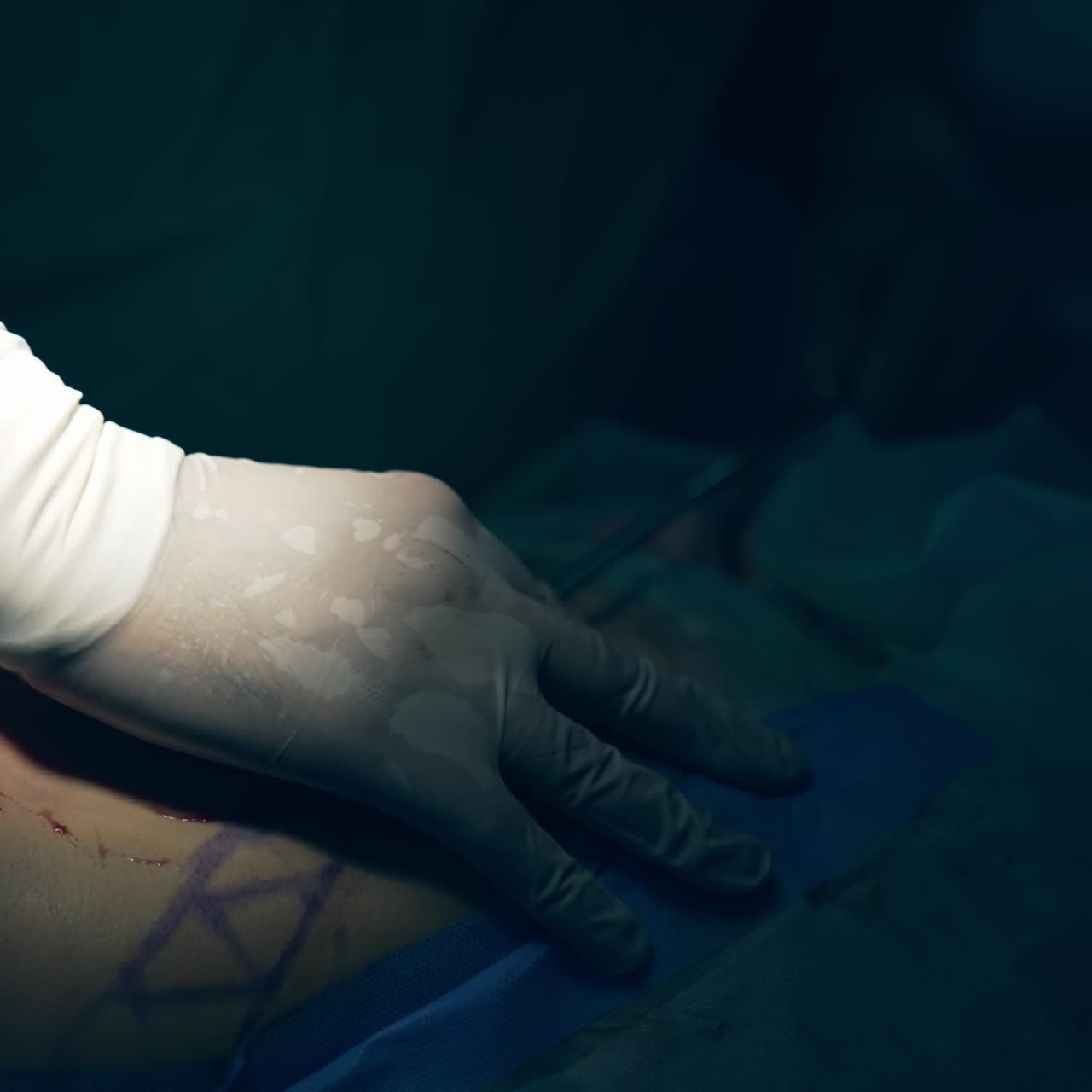 Liposuction process. Doctor's hands on patient's belly with surgical tool during removing fat. Abdominal procedure. Close-up