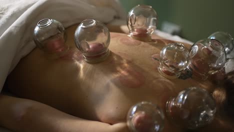 woman laying on stomach with cupping therapy suction cups attached on her back