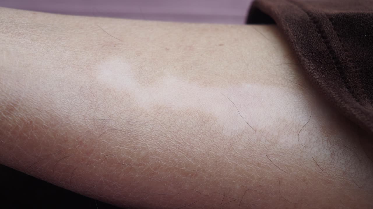 vitiligo en el brazo