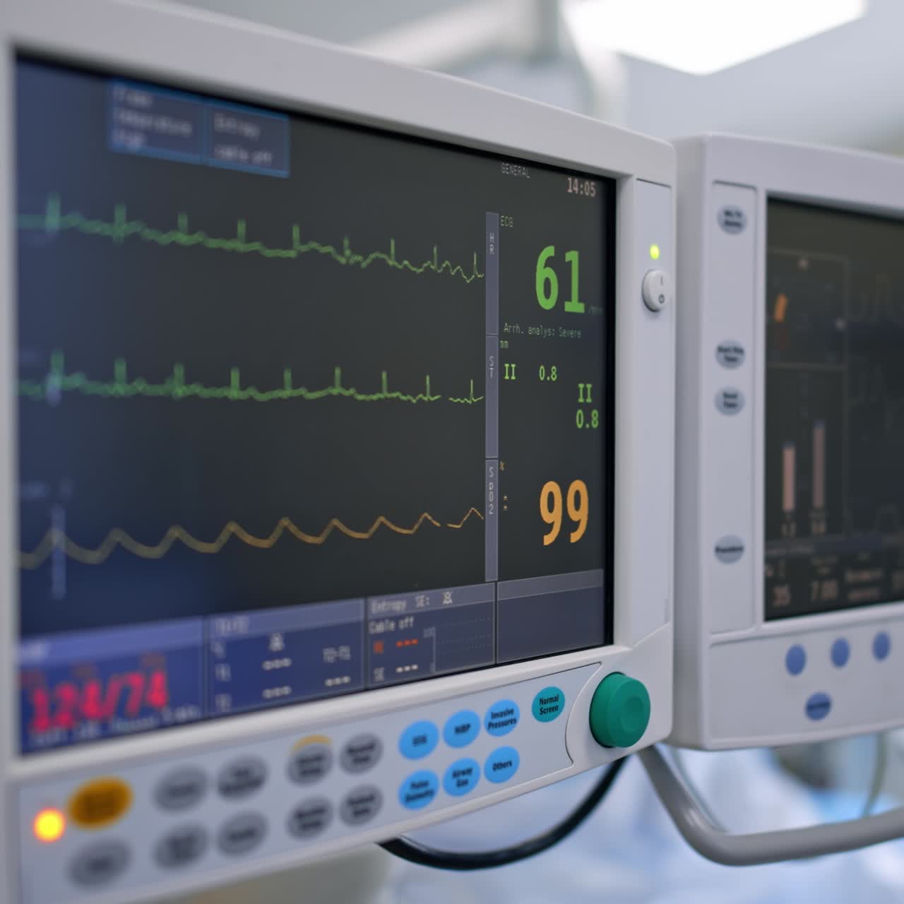 Polso e frequenza cardiaca di un paziente durante l'intervento. Primo piano sui monitor del ventilatore polmonare