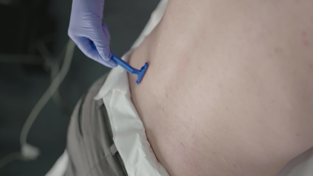 Gloved technician shaving patient's back in preparation for laser hair removal - vertical video