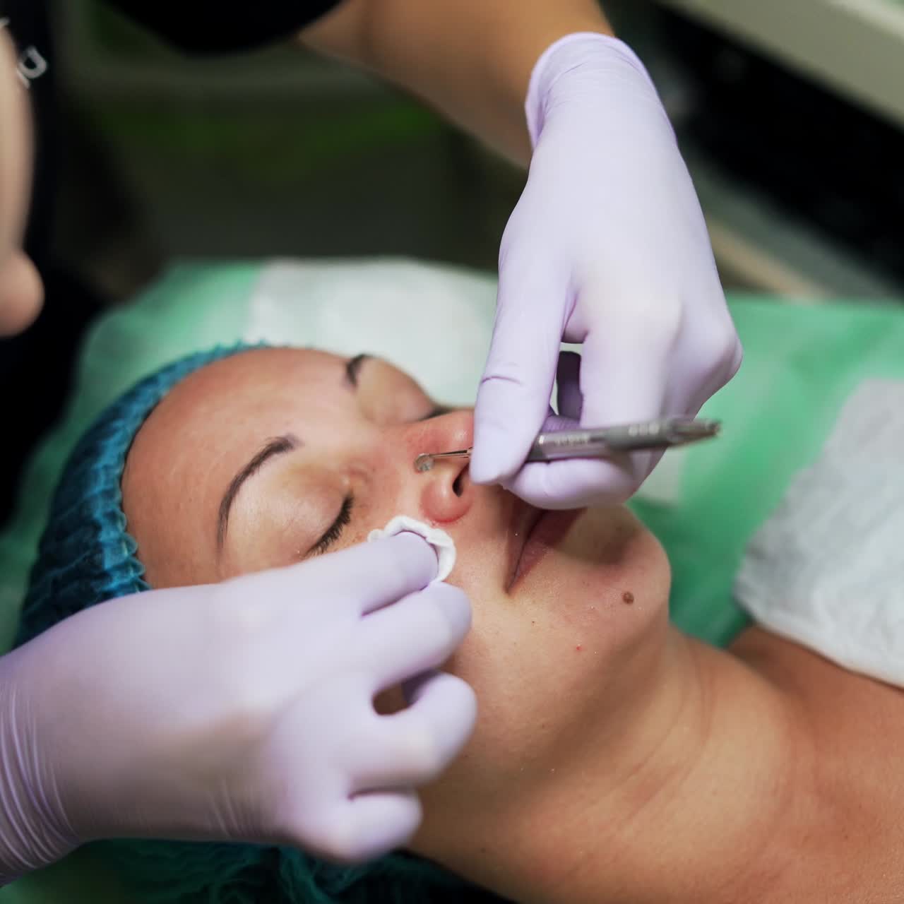 Pulizia dei pori in un centro estetico. Una donna caucasica si sottopone alla rimozione dei punti neri con uno strumento cosmetologico. Vista dall'alto