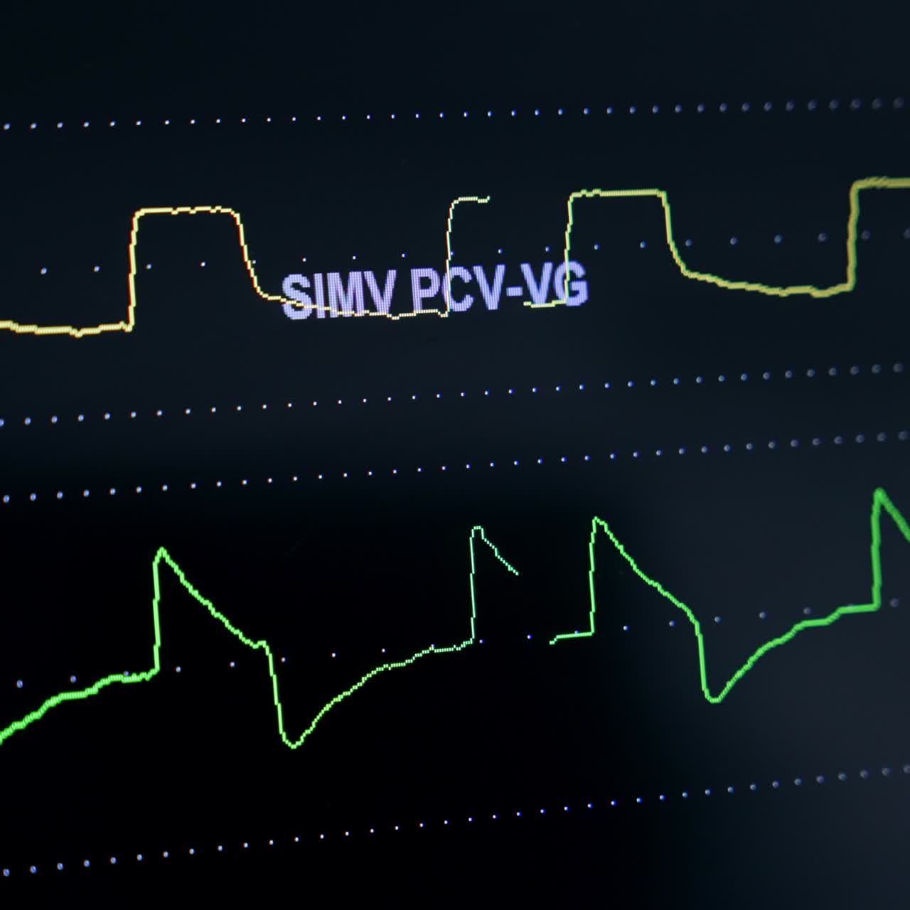 Curves of life parameters of a patient on the black screen of monitor. Extreme close up. Equipment working at operation
