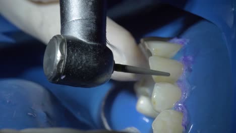 dentist precisely shapes denture with aerotor machine in clinical setting